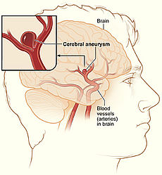 Spine Neurosurgery