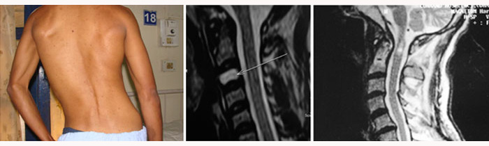 Spine Neurosurgery