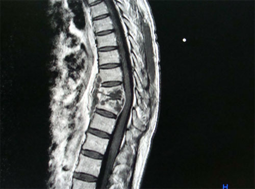 Spine X-ray
