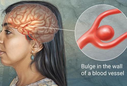 Intracranial Aneurysms: Clipping or Coiling?